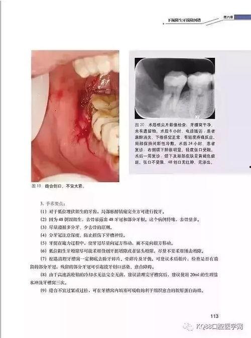 微创拔牙视频,轻松实现牙齿健康